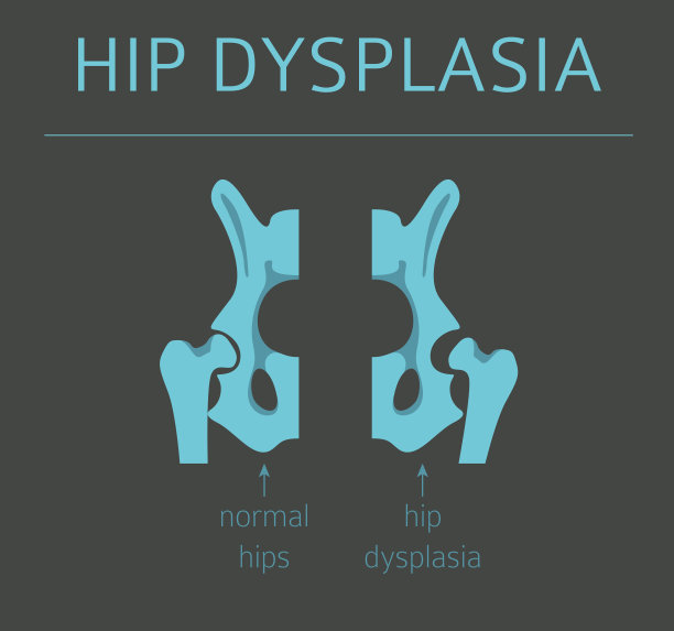 足部变形类型，医疗疾病信息图表。儿童髋关节发育不良图片下载