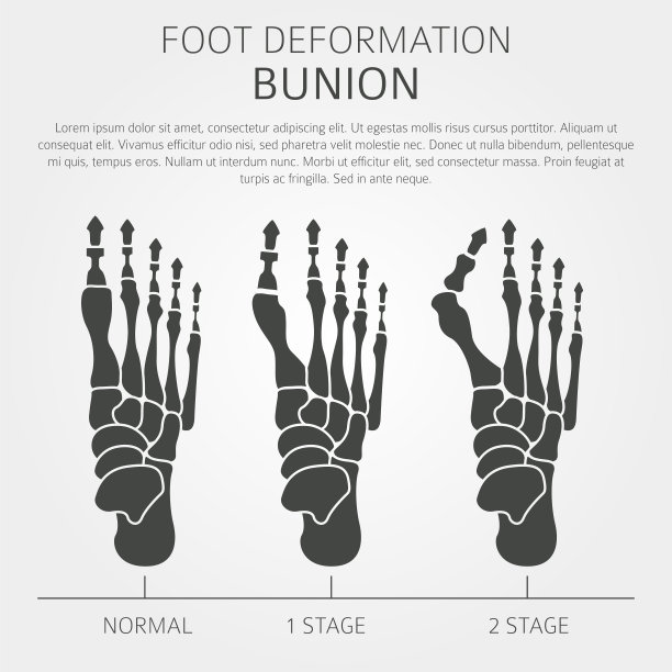 足部变形为医疗疾病信息图。拇外翻的原因图片下载