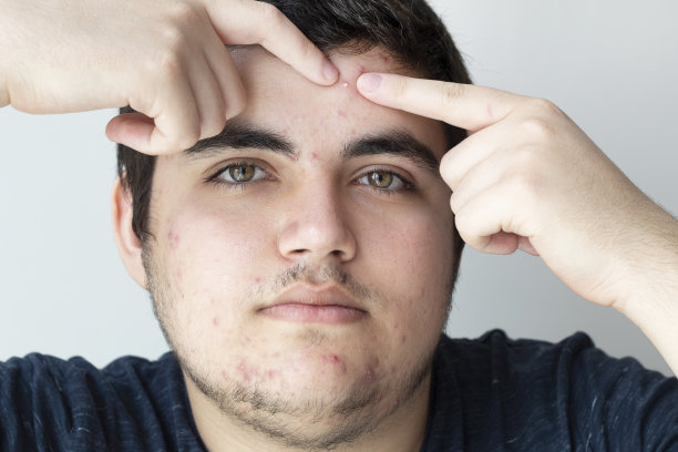 一幅寻找脸上粉刺的年轻人的肖像图片下载