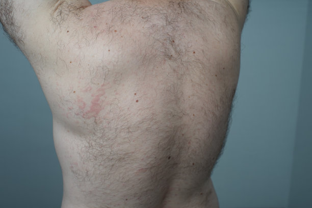 过敏反应是年轻男子身上出现红斑。图片下载