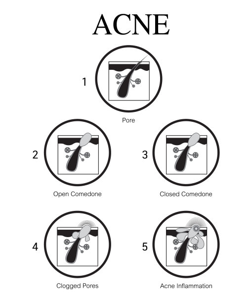 痤疮发展健康的皮肤设计图片下载