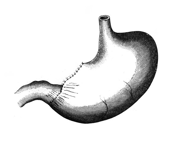 在旧书《外科手术》中，阿尔伯特医生，维也纳，1882年手术的胃图片下载