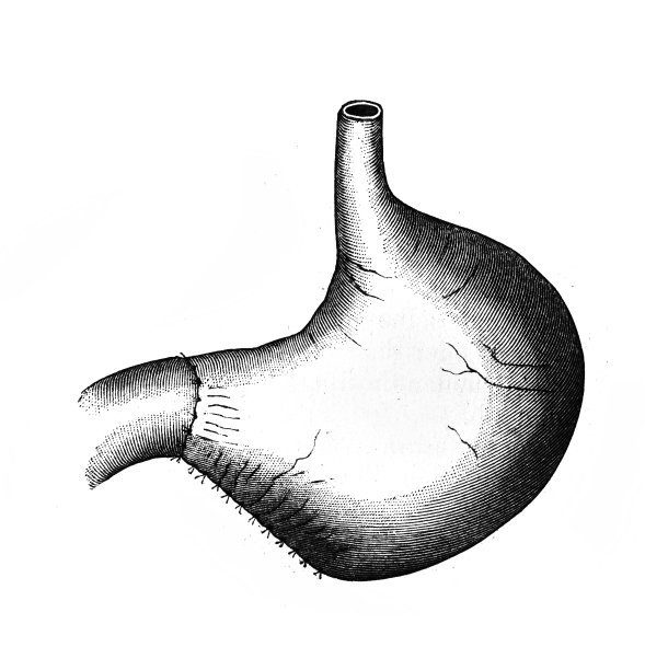在旧书《外科手术》中，阿尔伯特医生，维也纳，1882年手术的胃图片下载