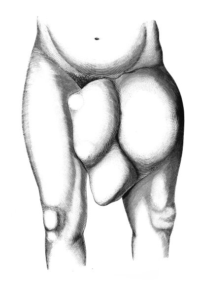 1882年，在旧书《外科手术》中，一个女人在两腿之间的大肿胀图片下载