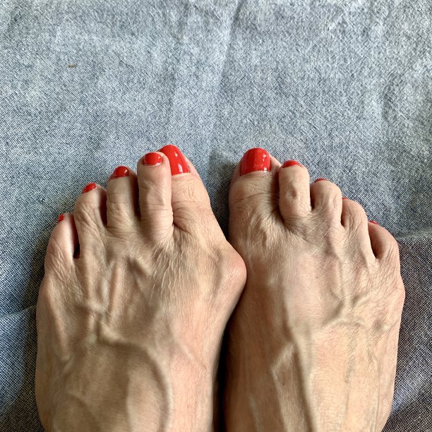 拇外翻的脚上图片下载