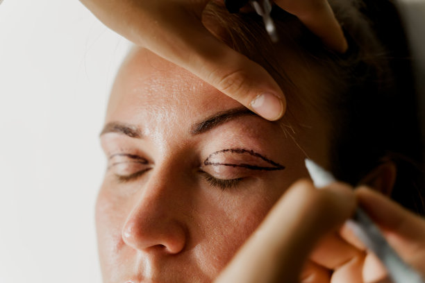 眼睑成形术在整形手术前对脸部进行近距离标记，以改善面部的眼部区域。2 .医生做整容手术图片下载