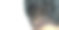 发丝后移的男性头部植发手术，FUE，毛囊单位提取，植发手术的类型及分期。男性脱发的治疗。图片下载
