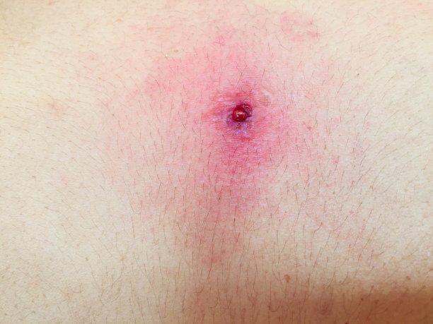 皮肤上的疖子图片下载