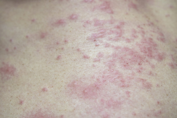 发痒的皮疹图片下载