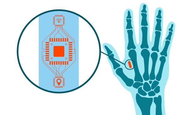 在x光下皮下植入微芯片。人凿的概念。监视人。未来凿技术。白色背景上的插图。图片下载