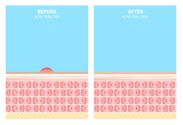 痘痘皮肤斑点痘痘问题向量设计。图片下载