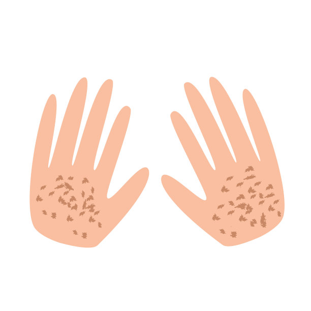 手上的雀斑皮肤上的色素沉着图片下载