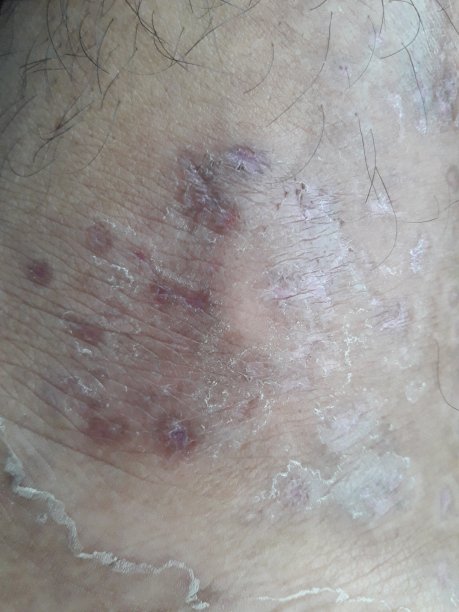 很痛，很严重的皮肤病在男人的左腿上。图片下载