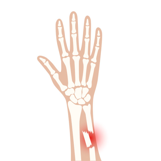 骨折x射线概念图片下载