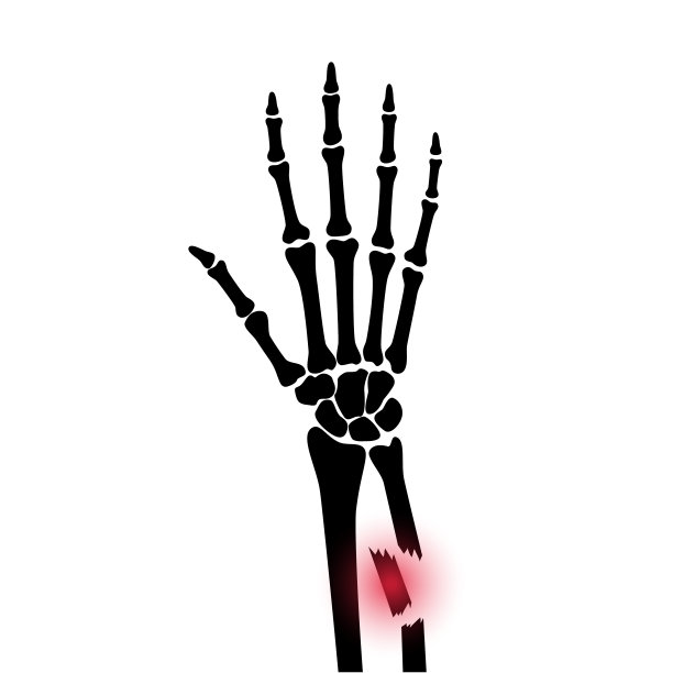 骨折x射线概念图片下载