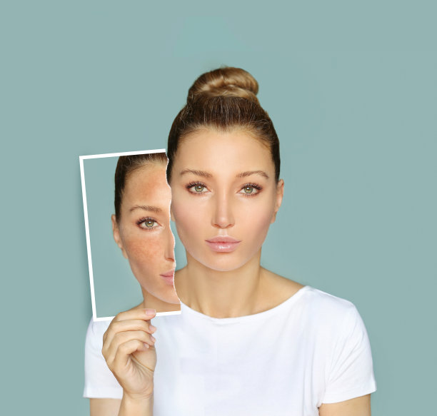 黑斑，雀斑，色素沉着(黄褐斑或黄褐斑)，概念——亮肤，美白，亮肤图片下载