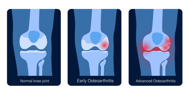 膝关节关节炎图片下载