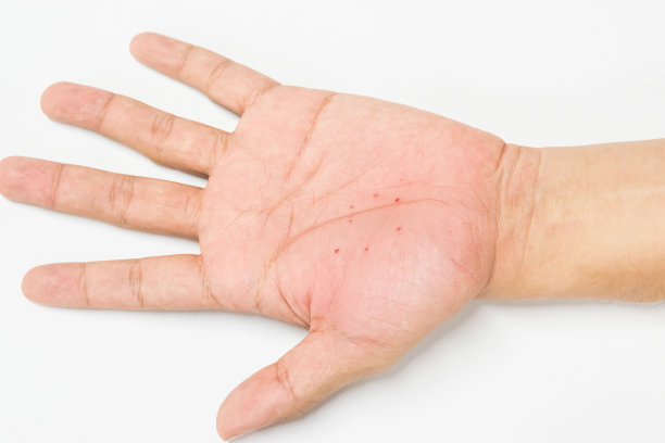 手部特应性皮炎(AD)，又称特应性湿疹图片下载