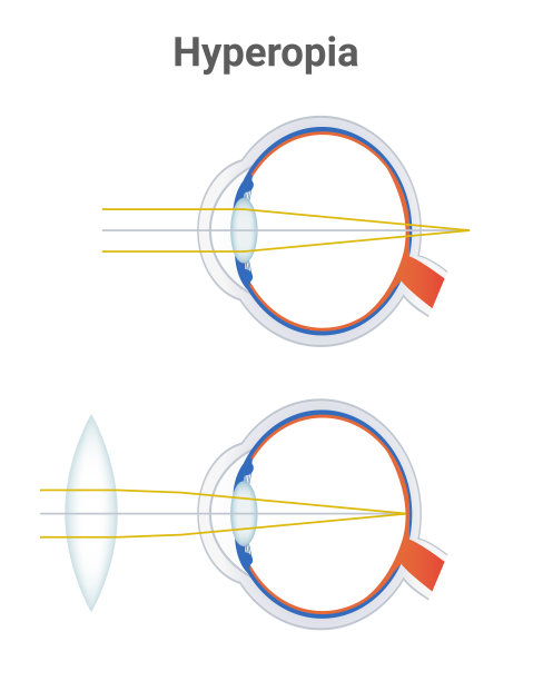 远视，远视障碍，用正透镜或双凸正透镜矫正视力。光线在视网膜后聚焦。插图被孤立在白色背景上。图片下载