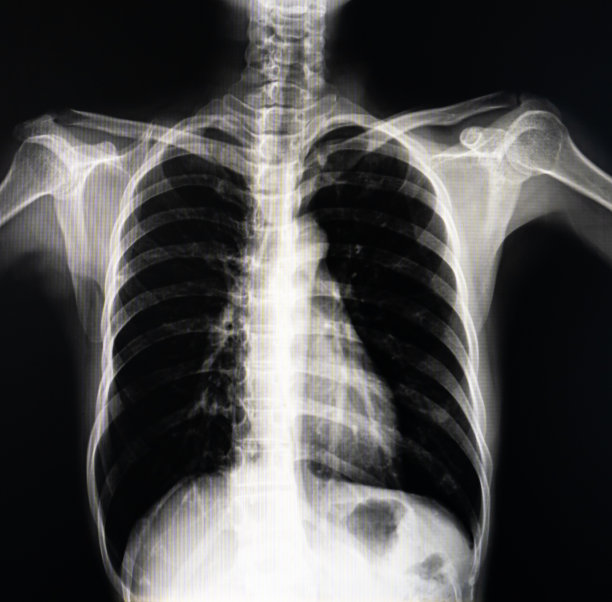 胸廓x线片图片下载