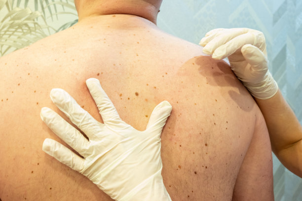 皮肤科医生在诊所用放大镜检查病人的胎记，特写图片下载