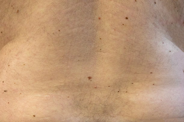 男人背部的痣，医生检查照片图片下载