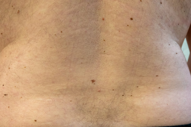 男人背部的痣，医生检查照片图片下载