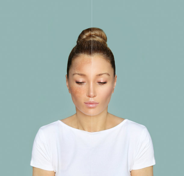 黑斑，雀斑，色素沉着(黄褐斑或黄褐斑)，概念——亮肤，美白，亮肤图片下载