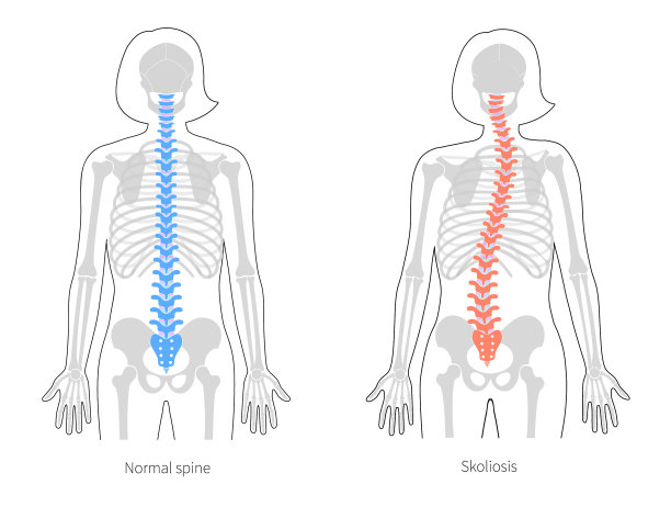 脊柱侧凸平图片下载