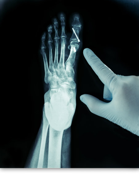 拇外翻手术后前脚x光片蓝色手套图片下载