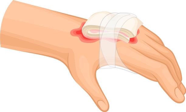 被烧伤或烧伤的手的急救图片下载