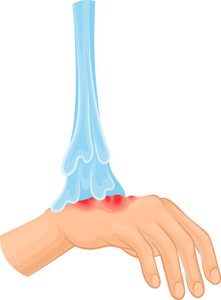 被烧伤或烧伤的手的急救图片下载