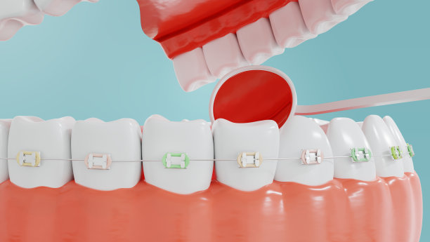 牙科美容与正畸支架在透明的白色牙齿在蓝色的背景。3 d渲染。图片下载