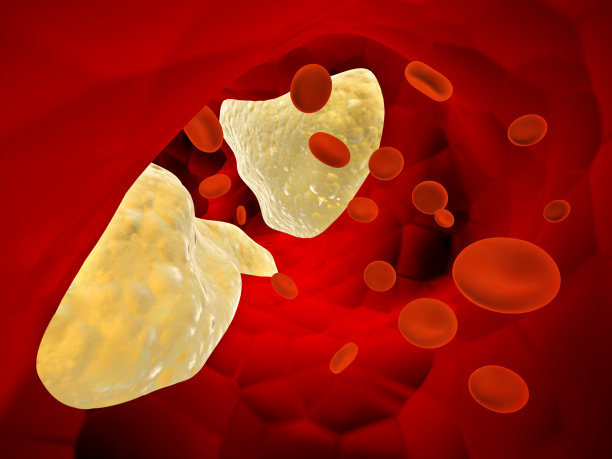 动脉(动脉粥样硬化)和红细胞中的胆固醇斑块图片下载
