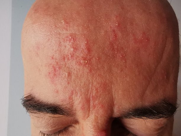 酒渣鼻图片下载