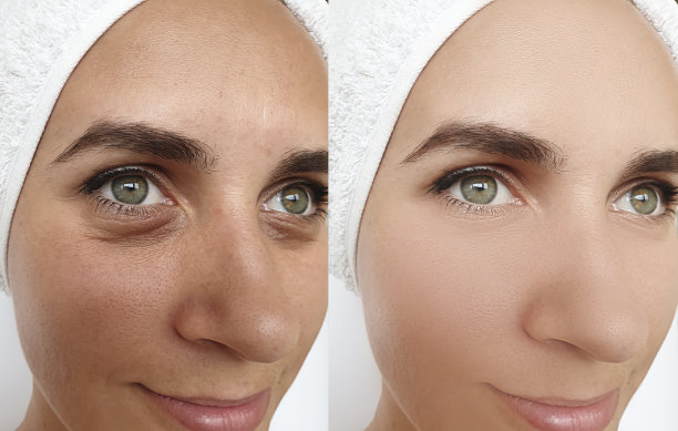 女性面部皱纹治疗前后图片下载