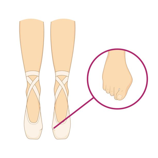 职业芭蕾舞者拇外翻病。图片下载
