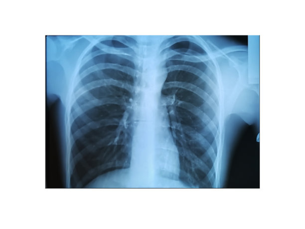 标准的胸部全景x光片-健康的心脏和肺图片下载
