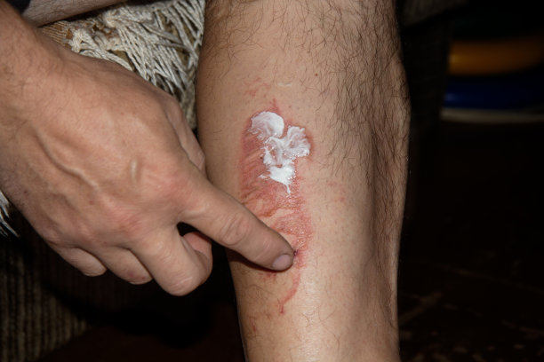 男人的手把奶油涂在烧伤的大腿上。图片下载