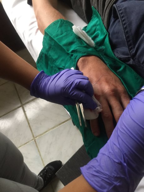 有一个大伤口正在接受缝针的手图片下载