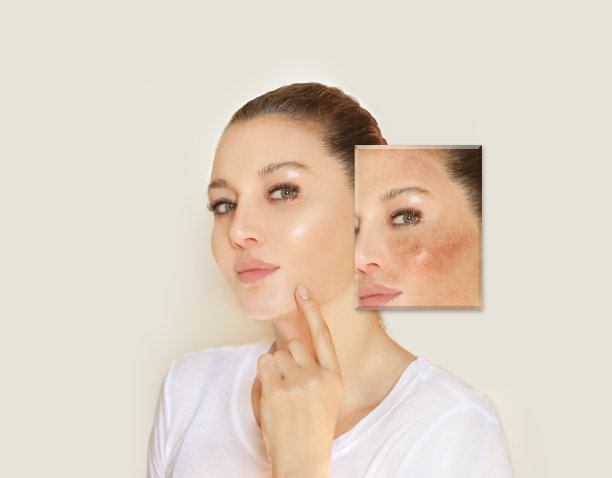 黑斑，雀斑，色素沉着(黄褐斑或黄褐斑)，概念——亮肤，美白，亮肤图片下载