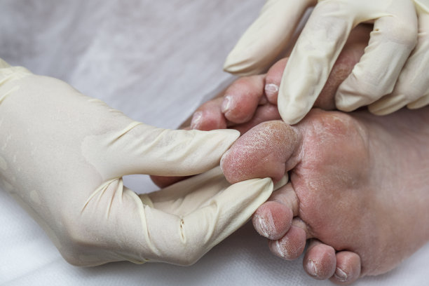 女性糖尿病足有问题。图片下载