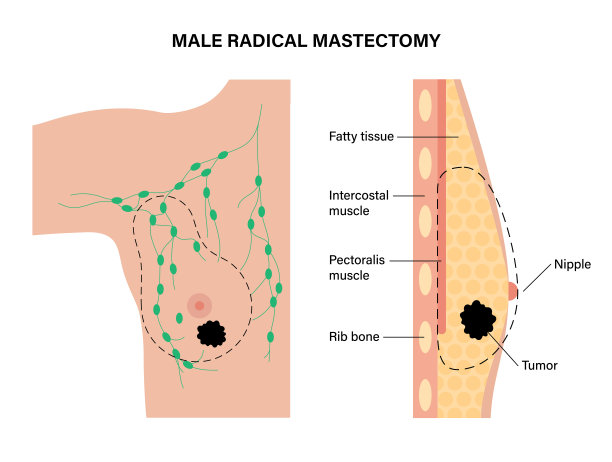 乳腺癌概念图片下载