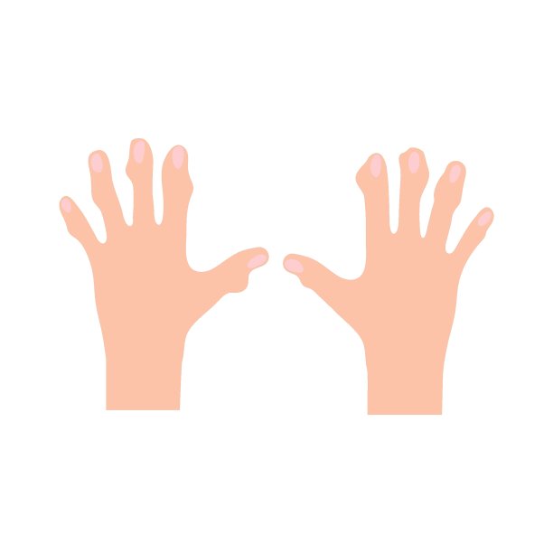 关节炎是人类手部关节的一种疾病。医学的概念。图片下载