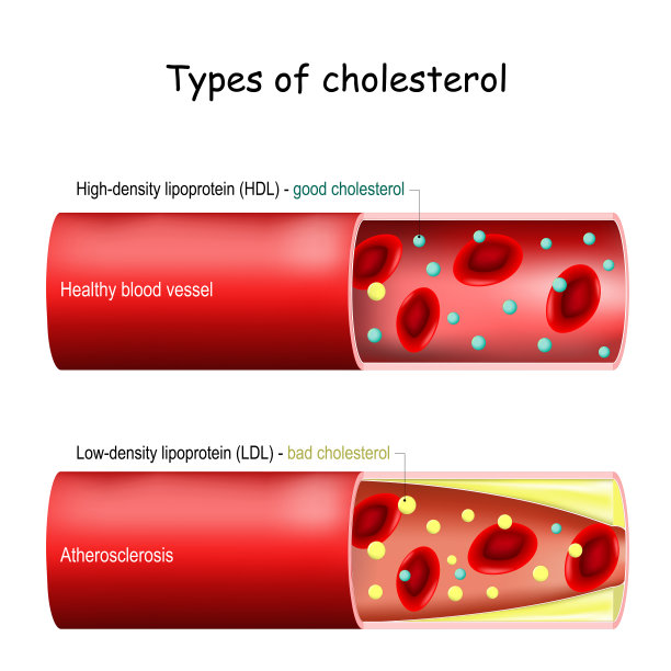 类型的胆固醇。正常和狭窄的动脉来解释疾病。图片下载