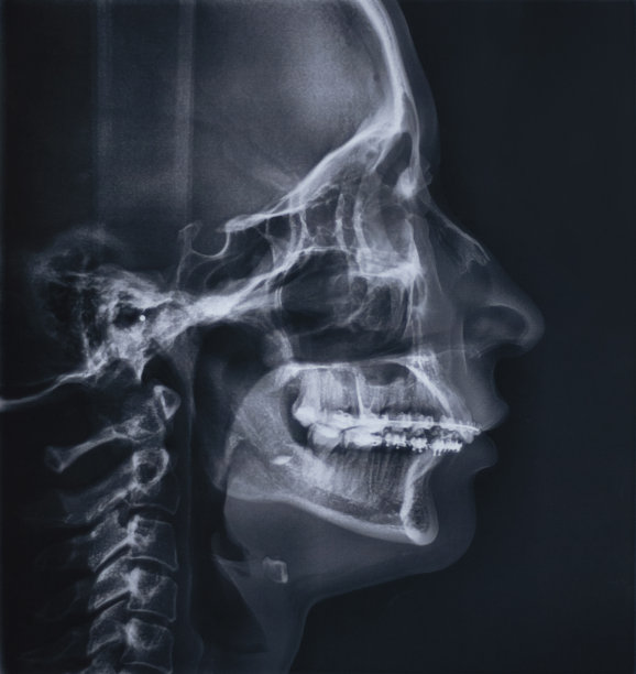 Teleroentgenographic x射线图像图片下载