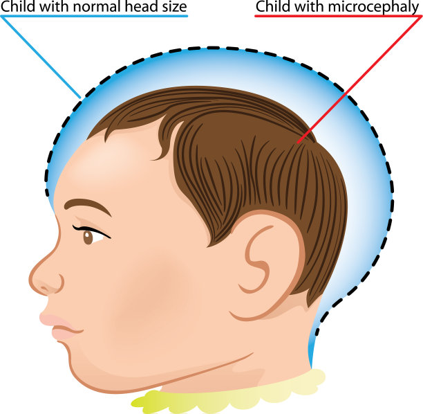 一个新生儿患有小头症图片下载