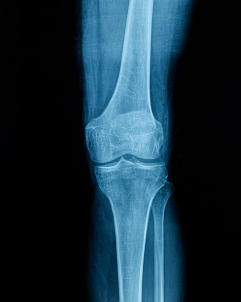 人体腿部和膝盖x光图像图片下载
