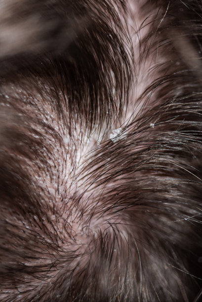 一个年轻人的头皮屑和头发问题图片下载