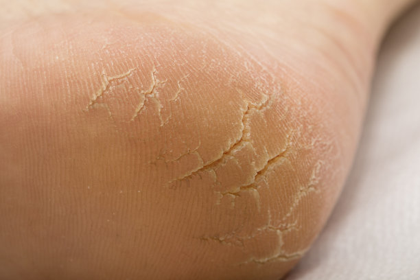 鞋跟有很深的裂缝。图片下载